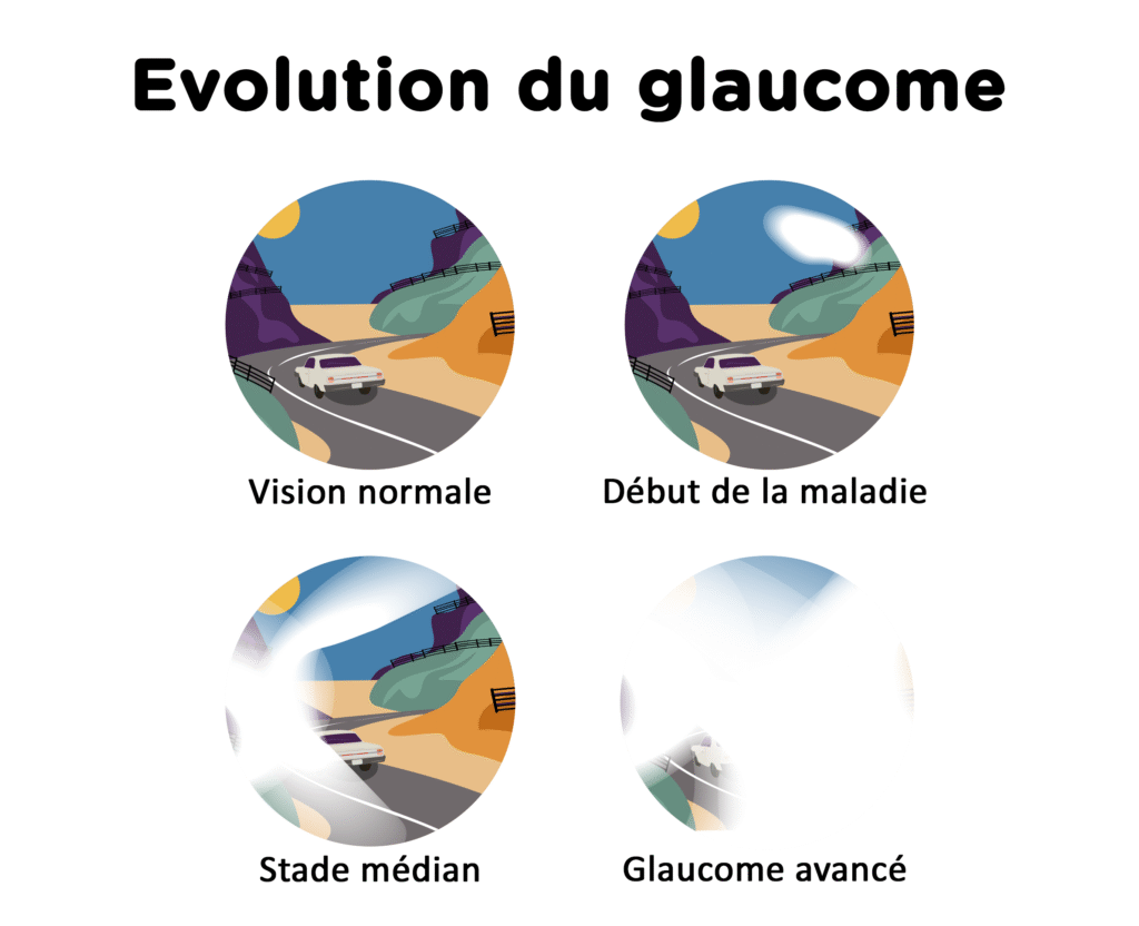 evolution du glaucome
